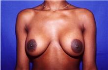 Breast Augmentation After Photo by Theodore Diktaban, MD; New York, NY - Case 40888