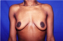 Breast Augmentation Before Photo by Theodore Diktaban, MD; New York, NY - Case 40888