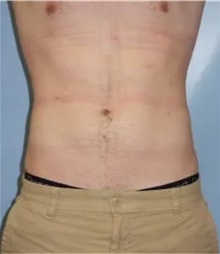 Liposuction After Photo by Theodore Diktaban, MD; New York, NY - Case 41274