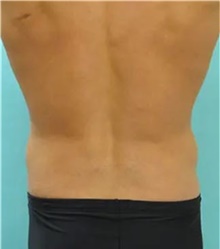 Liposuction After Photo by Theodore Diktaban, MD; New York, NY - Case 41275