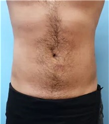 Liposuction After Photo by Theodore Diktaban, MD; New York, NY - Case 41276