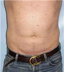 Liposuction After Photo by Theodore Diktaban, MD; New York, NY - Case 41277