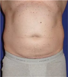 Liposuction Before Photo by Theodore Diktaban, MD; New York, NY - Case 41277