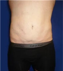 Liposuction After Photo by Theodore Diktaban, MD; New York, NY - Case 41278