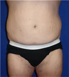 Liposuction Before Photo by Theodore Diktaban, MD; New York, NY - Case 41278