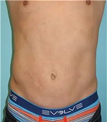Liposuction After Photo by Theodore Diktaban, MD; New York, NY - Case 41279