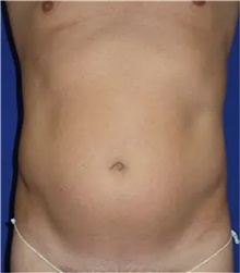 Liposuction Before Photo by Theodore Diktaban, MD; New York, NY - Case 41279