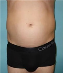 Liposuction Before Photo by Theodore Diktaban, MD; New York, NY - Case 41280
