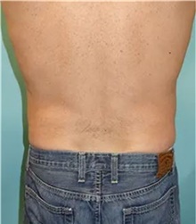 Liposuction After Photo by Theodore Diktaban, MD; New York, NY - Case 41281