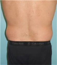 Liposuction Before Photo by Theodore Diktaban, MD; New York, NY - Case 41281