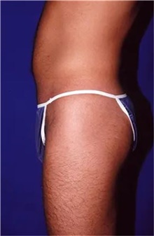 Liposuction Before Photo by Theodore Diktaban, MD; New York, NY - Case 41282