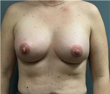 Breast Augmentation After Photo by Matthew Camp, MD; Edina, MN - Case 34020