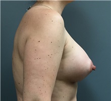 Breast Augmentation After Photo by Matthew Camp, MD; Edina, MN - Case 34020