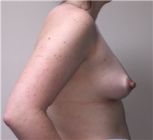 Breast Augmentation Before Photo by Matthew Camp, MD; Edina, MN - Case 34020