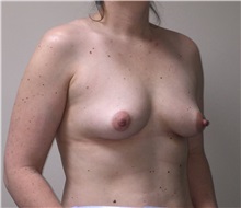 Breast Augmentation Before Photo by Matthew Camp, MD; Edina, MN - Case 34020