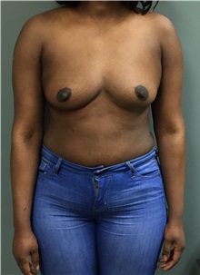 Breast Augmentation Before Photo by Matthew Camp, MD; Edina, MN - Case 35268
