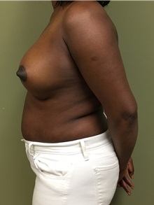 Breast Augmentation After Photo by Matthew Camp, MD; Edina, MN - Case 35268