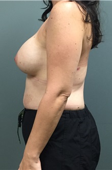 Breast Augmentation After Photo by Matthew Camp, MD; Edina, MN - Case 35269