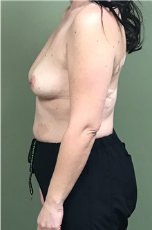 Breast Augmentation Before Photo by Matthew Camp, MD; Edina, MN - Case 35269