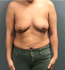 Breast Augmentation Before Photo by Matthew Camp, MD; Edina, MN - Case 35270