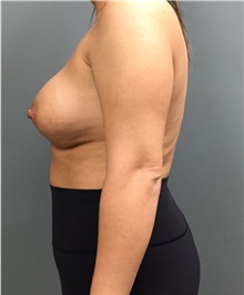Breast Augmentation After Photo by Matthew Camp, MD; Edina, MN - Case 35270