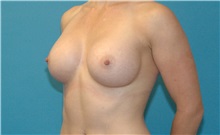 Breast Augmentation After Photo by Scott Sattler, MD,  FACS; Seattle, WA - Case 34347