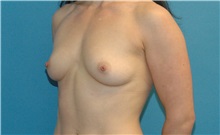 Breast Augmentation Before Photo by Scott Sattler, MD,  FACS; Seattle, WA - Case 34347