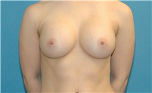 Breast Augmentation After Photo by Scott Sattler, MD,  FACS; Seattle, WA - Case 38394
