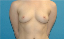 Breast Augmentation Before Photo by Scott Sattler, MD,  FACS; Seattle, WA - Case 38394