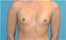 Breast Augmentation Before Photo by Scott Sattler, MD,  FACS; Seattle, WA - Case 38395