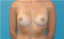 Breast Implant Revision After Photo by Scott Sattler, MD,  FACS; Seattle, WA - Case 38412
