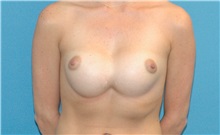 Breast Implant Revision Before Photo by Scott Sattler, MD,  FACS; Seattle, WA - Case 38412