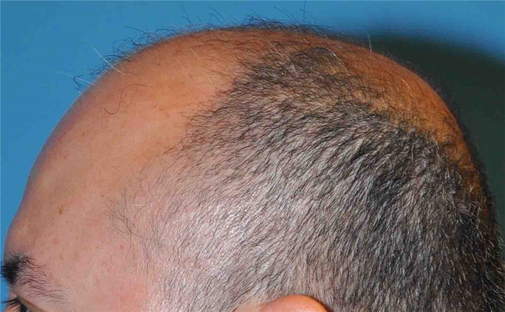 Hair Transplant Before and After Photos by Scott Sattler, MD, FACS;  Seattle, WA - Case 38413 | ASPS