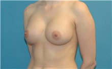 Breast Augmentation After Photo by Scott Sattler, MD,  FACS; Seattle, WA - Case 38415