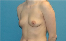 Breast Augmentation Before Photo by Scott Sattler, MD,  FACS; Seattle, WA - Case 38415