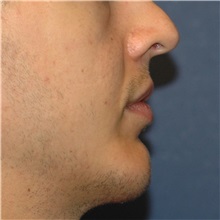 Chin Augmentation After Photo by Scott Sattler, MD,  FACS; Seattle, WA - Case 38592