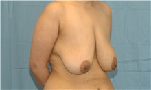 Breast Lift Before Photo by Scott Sattler, MD,  FACS; Seattle, WA - Case 38594
