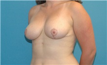 Breast Reduction After Photo by Scott Sattler, MD,  FACS; Seattle, WA - Case 38600