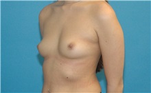 Breast Augmentation Before Photo by Scott Sattler, MD,  FACS; Seattle, WA - Case 38601