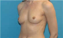 Breast Augmentation Before Photo by Scott Sattler, MD,  FACS; Seattle, WA - Case 38603