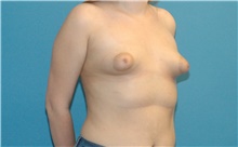 Breast Augmentation Before Photo by Scott Sattler, MD,  FACS; Seattle, WA - Case 40688