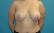 Breast Reduction Before Photo by Scott Sattler, MD,  FACS; Seattle, WA - Case 40689