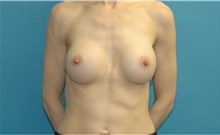 Breast Augmentation After Photo by Scott Sattler, MD,  FACS; Seattle, WA - Case 41560