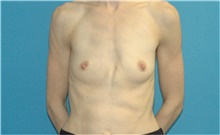 Breast Augmentation Before Photo by Scott Sattler, MD,  FACS; Seattle, WA - Case 41560
