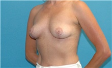 Breast Implant Removal After Photo by Scott Sattler, MD,  FACS; Seattle, WA - Case 41856