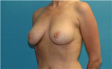 Breast Implant Removal Before Photo by Scott Sattler, MD,  FACS; Seattle, WA - Case 41856