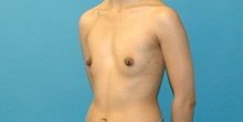 Breast Augmentation Before Photo by Scott Sattler, MD,  FACS; Seattle, WA - Case 41859