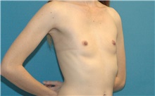 Breast Augmentation Before Photo by Scott Sattler, MD,  FACS; Seattle, WA - Case 41860