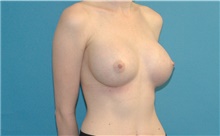 Breast Augmentation After Photo by Scott Sattler, MD,  FACS; Seattle, WA - Case 41863