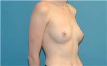 Breast Augmentation Before Photo by Scott Sattler, MD,  FACS; Seattle, WA - Case 41863